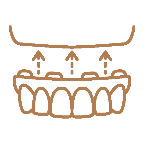 Implant-supported dental bridge diagram showing tooth replacement prosthetics with upward arrows indicating support mechanism.