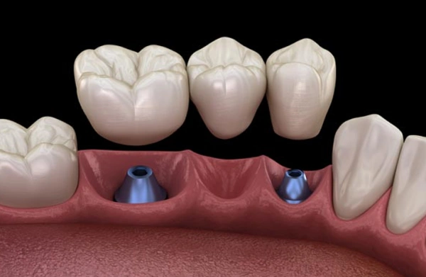 Dental implants illustration showing two blue implant posts in gum with crown restorations above.