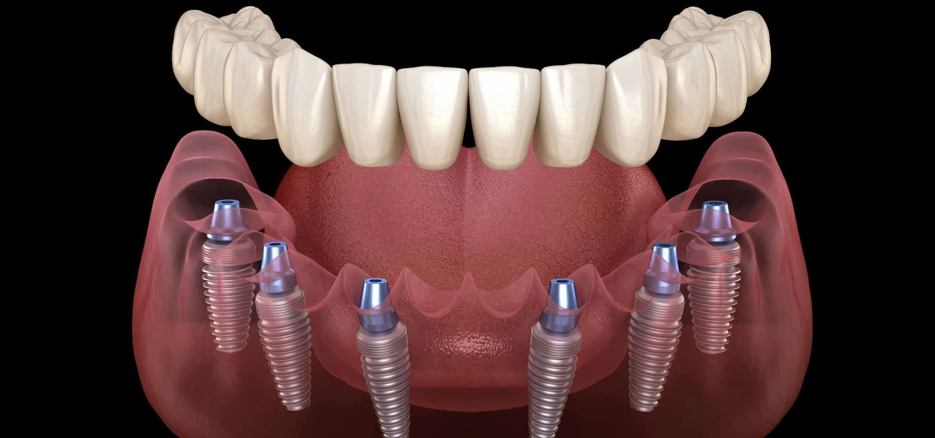 Dental implants illustration showing prosthetic teeth on jawbone model with implant posts.