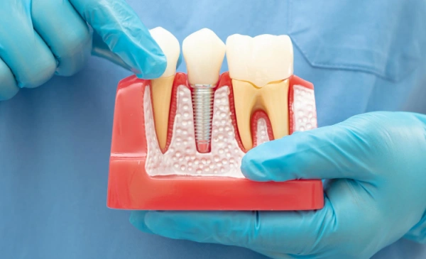 Dental professional demonstrates tooth and gum anatomy using educational model with gloved hands.