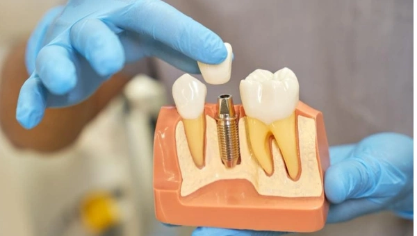 Dentist in blue gloves demonstrates dental implant on anatomical model showing tooth structure.