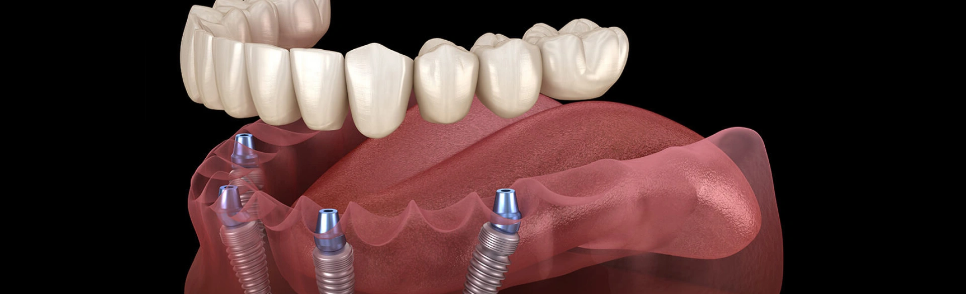 Dental implant bridge prosthesis displayed above model jaw with two titanium implant posts