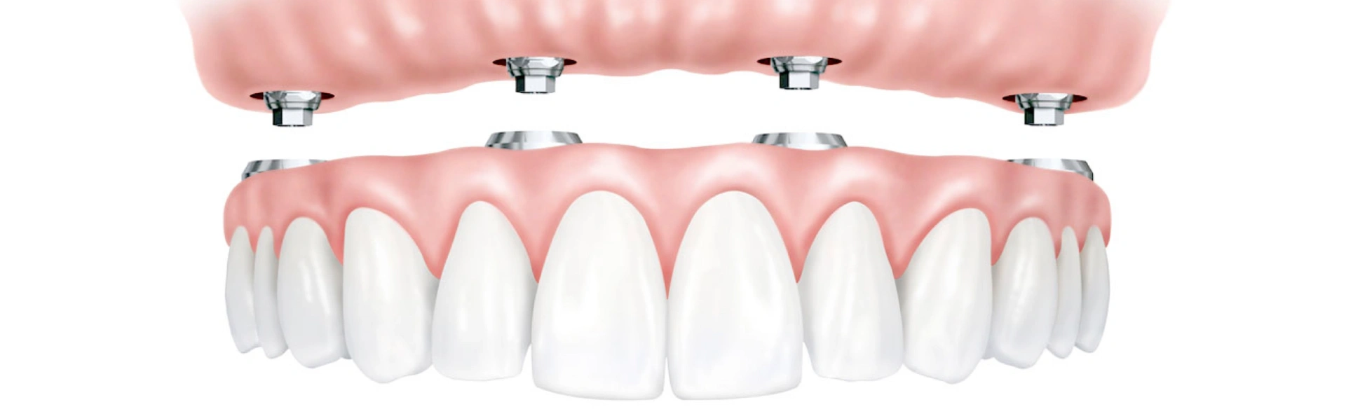 Digital illustration of dental implant bridge showing artificial teeth structure and gum design for smile restoration.