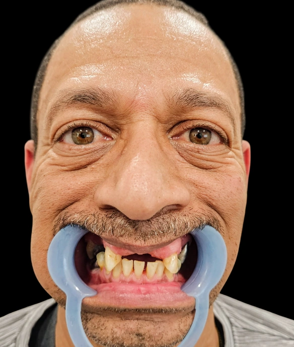 Man demonstrating exaggerated dental stretching exercise with blue resistance bands around mouth.