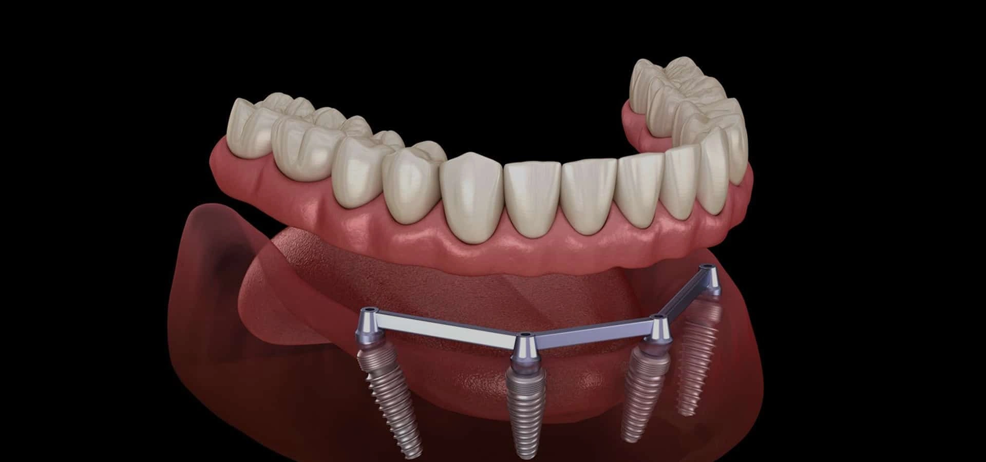 Dental implant prosthesis model showing artificial teeth attached to jawbone with support posts