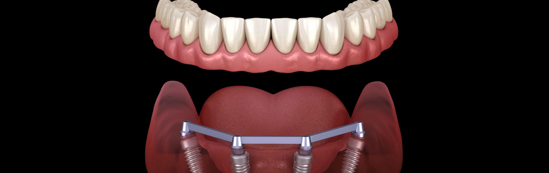 Dental implant prosthesis showing artificial teeth attached to lower jawbone model against black background.