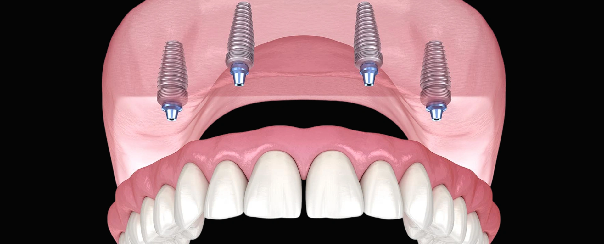 Dental implant model showing four titanium posts anchored in pink gum tissue supporting prosthetic teeth.